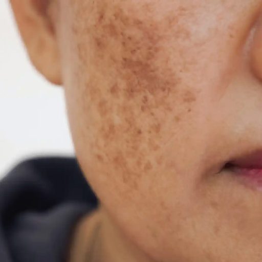 Melasma-2