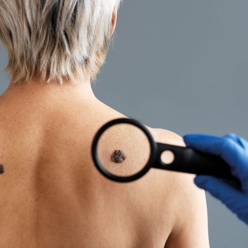 skin-cancer-web